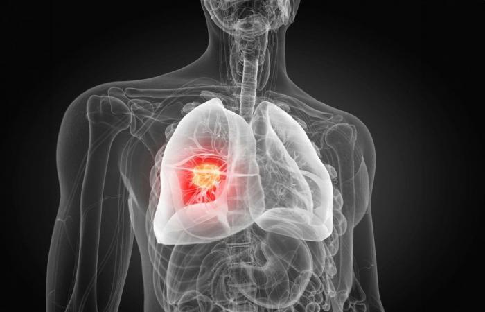 pourquoi les traitements contre le cancer du poumon échouent souvent chez les non-fumeurs