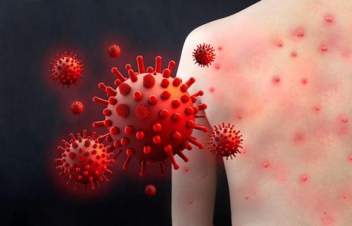La première victime du mpox révélée, que faut-il savoir ? – .
