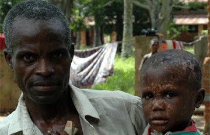 Monkeypox déclarée au Nord Kivu