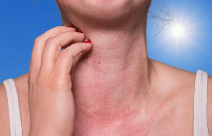 Comment reconnaître une allergie au soleil (et que faire) ? – .
