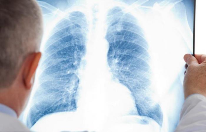 pourquoi sont-ils également touchés par le cancer du poumon ? – .