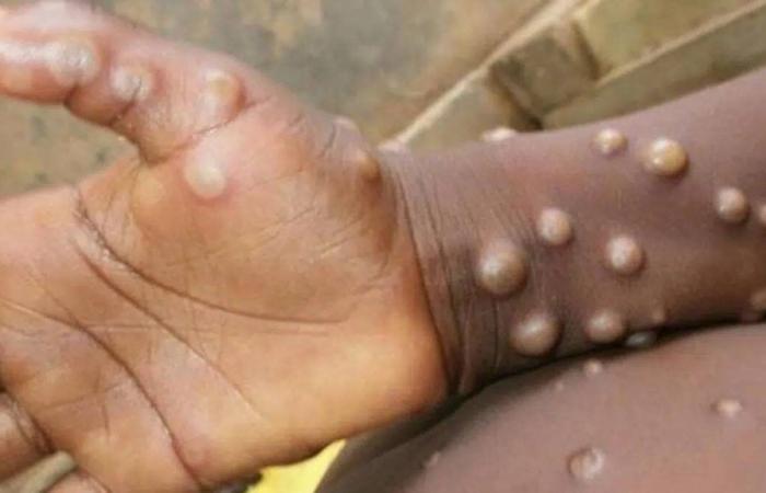 Nouvelle souche de variole en RDC : la menace s’accroît