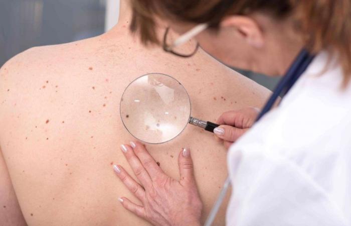 Comment reconnaître les premiers signes du cancer de la peau ? – .