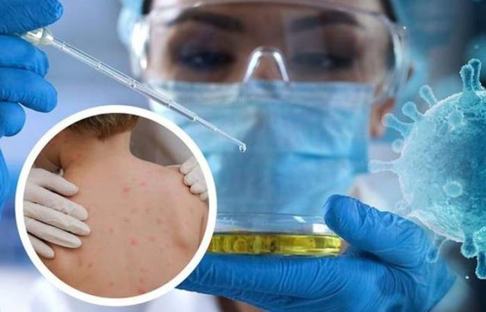 Le
      Maroc
      enregistre
      son
      premier
      cas
      de
      Mpox