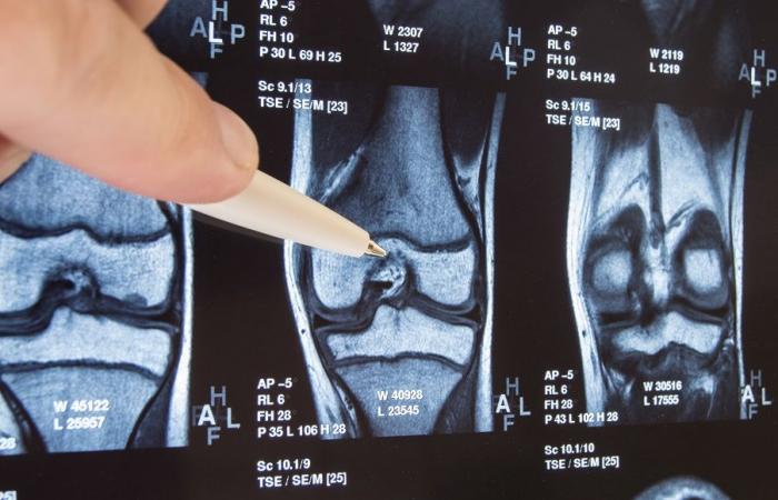 Le matériau à base d’acide hyaluronique qui régénère le cartilage