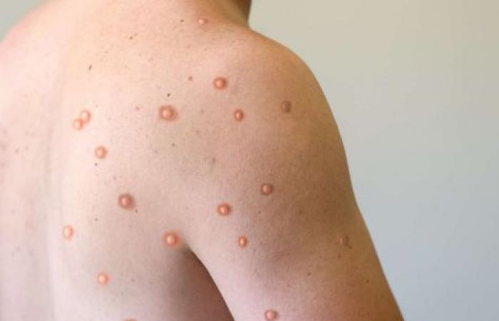 Comment se transmet le Monkeypox ?