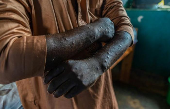 A Kamituga, les « péchés » à la source de l’épidémie de mpox en RDC – 30/09/2024 à 05:17