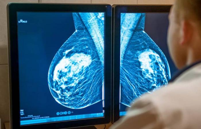 Augmentation des cas de cancer du sein chez les femmes de moins de 50 ans