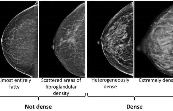 Des seins denses peuvent rendre plus difficile la détection du cancer