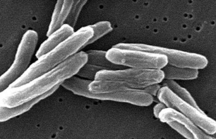 Forte hausse du nombre de cas de tuberculose au Québec