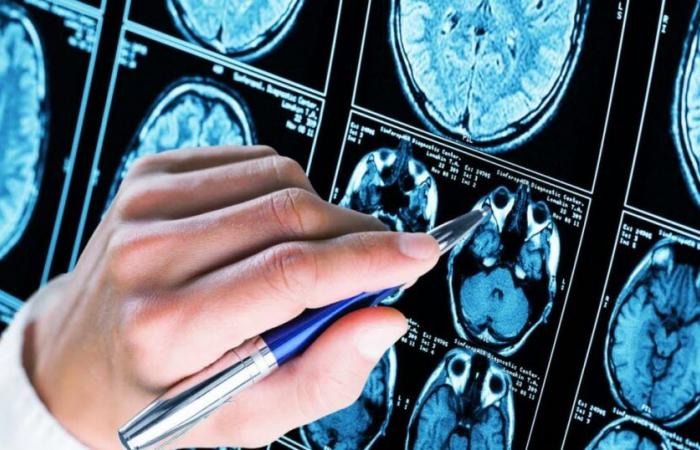 Étude. Un médicament prometteur contre la maladie d’Alzheimer