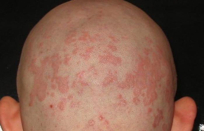 Découverte importante pour un dermatologue québécois