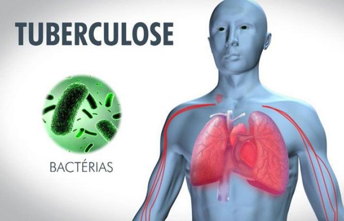 La tuberculose en 2023 atteint un record avec 8,2 millions de nouveaux cas