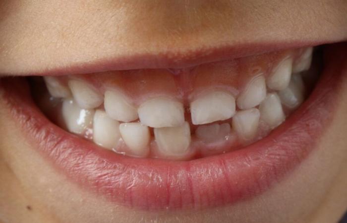 Qu’est-ce que le MIH, cette maladie qui détruit l’émail des dents des enfants et favorise les caries ?