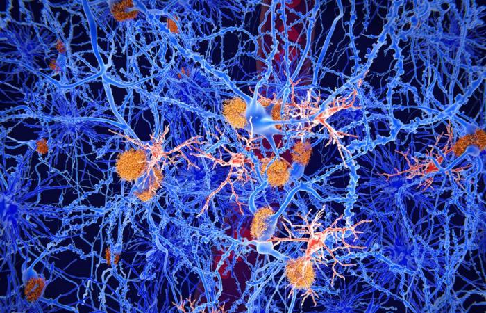 De nouveaux critères pour éviter le surdiagnostic de la maladie d’Alzheimer