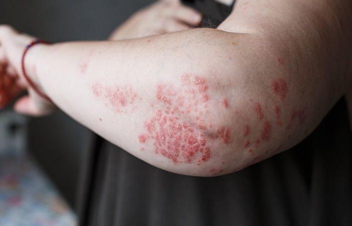 Zasocitinib, un autre inhibiteur de Tyk2 pour traiter le psoriasis oral