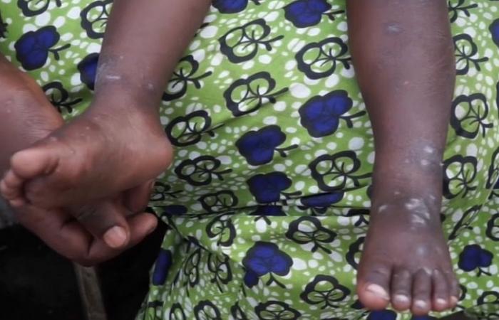 l’épidémie en hausse chez les enfants en RDC et au Burundi