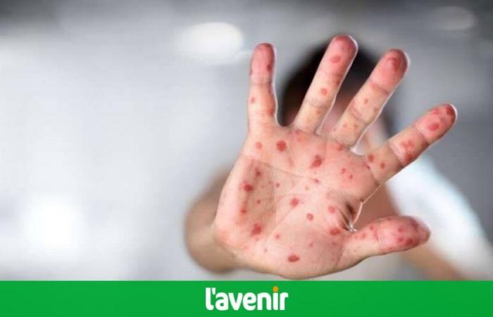 Les cas de rougeole ont grimpé en flèche dans le monde en 2023 : « Une couverture vaccinale insuffisante est à l’origine de cette augmentation » (infographie)