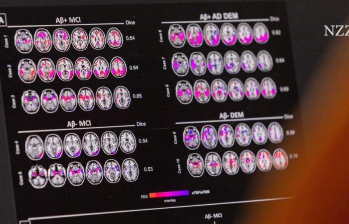 Le médicament contre la maladie d’Alzheimer, Leqembi, sera bientôt disponible dans l’UE