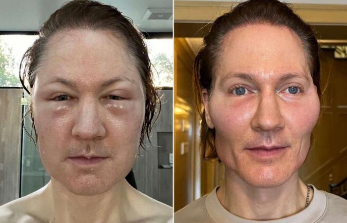 Les injections de graisse du « Project Baby Face » font « exploser » le visage d’un entrepreneur