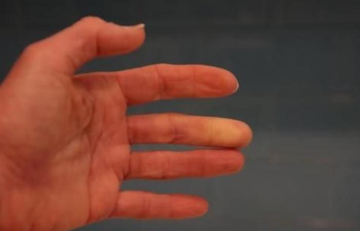 Vous avez les mains froides ? Ce test d’1 minute vous dira si vous souffrez du syndrome de Raynaud