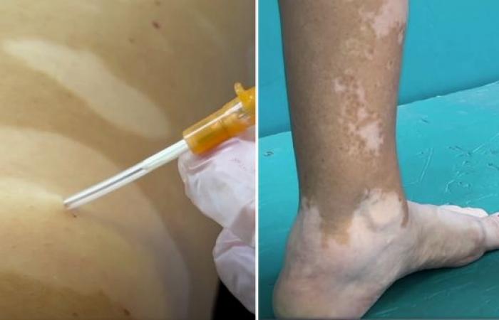 un remède contre le vitiligo testé à la Réunion