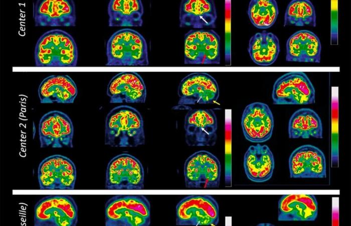 Ce que l’on sait de l’impact du Covid sur votre cerveau