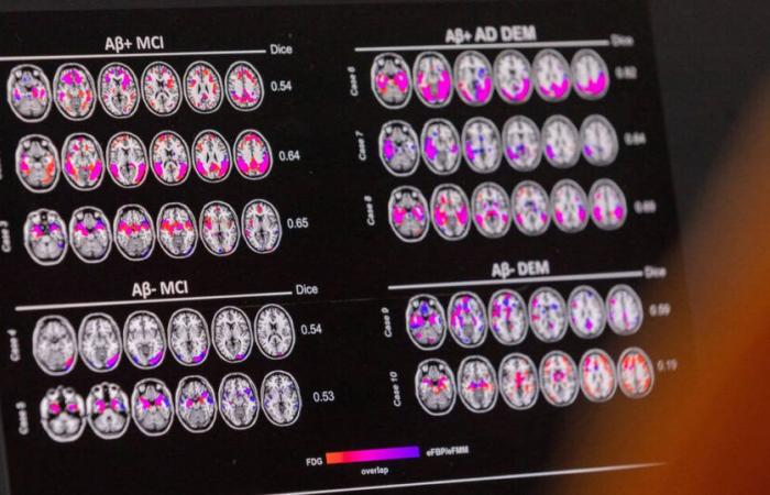 Et si la Haute Autorité de Santé faisait preuve d’indépendance sur les médicaments anti-Alzheimer ? – Libération