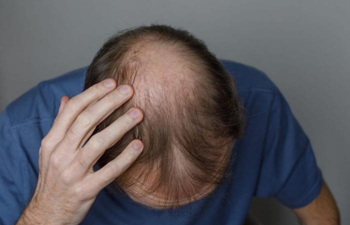 Ce traitement contre la perte de cheveux chez les hommes fonctionne mieux que les autres