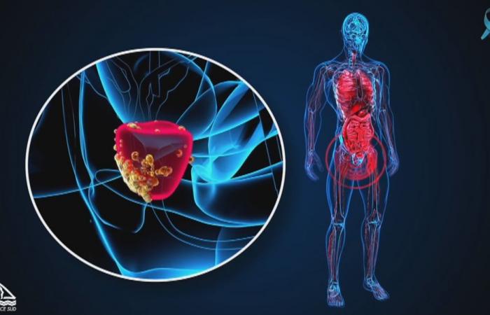 Six choses à savoir sur le cancer de la prostate en Nouvelle-Calédonie