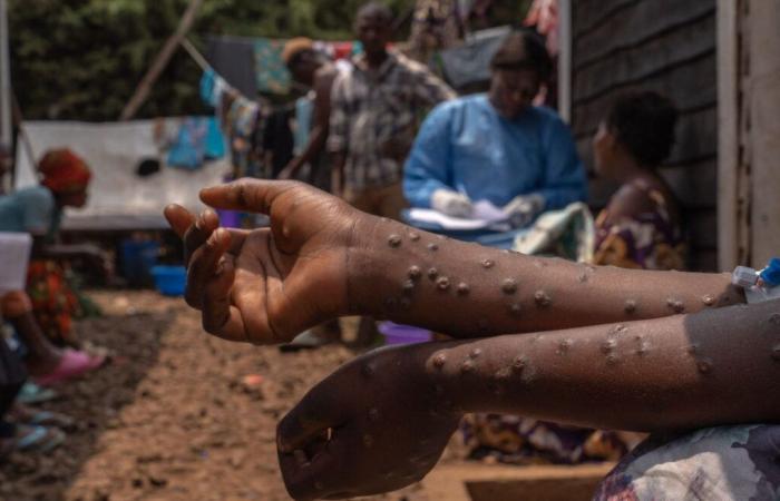 Mpox en RDC : l’OMS maintient son niveau d’alerte le plus élevé