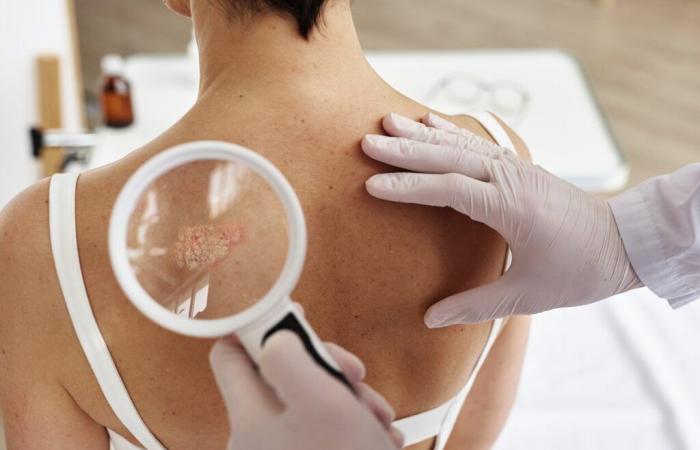 Nouvelles recommandations dans la prise en charge du psoriasis