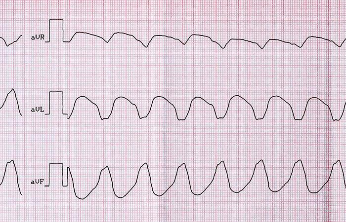 l’ablation de première intention, une option défendable