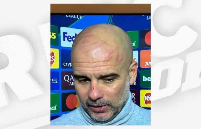 les égratignures effrayantes sur le visage de Guardiola après le match nul de Manchester City contre Feyenoord