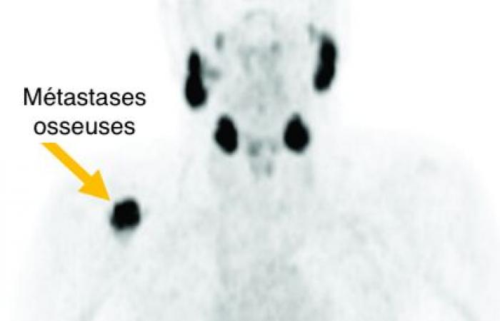 Lu-PSMA, le radiopharmaceutique qui s’attaque au cancer de la prostate