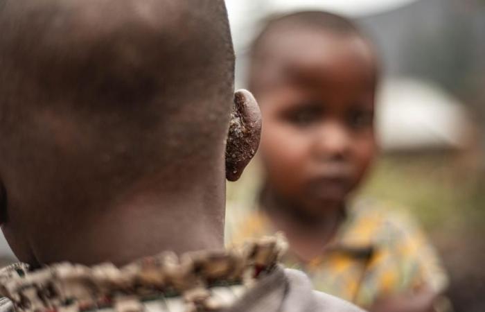 (Multimédia) Près de 60 000 cas de mpox en Afrique, 20 pays touchés (Africa CDC) – Xinhua