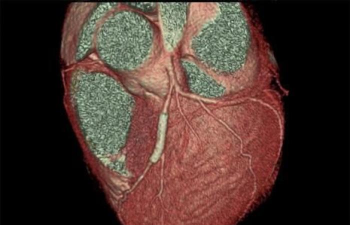 Après pose de stent, clopidogrel préférable à l’aspirine au long cours chez les patients à risque