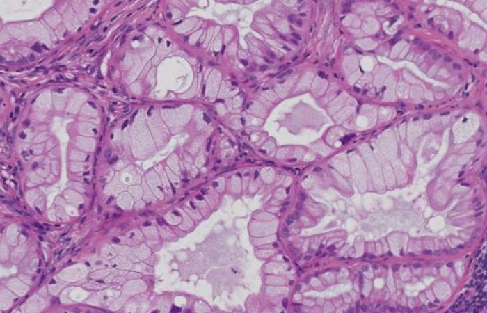 une piste sérieuse pour relancer les défenses anti-tumorales · Inserm, Science pour la santé