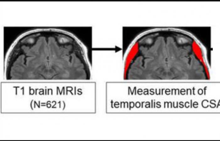 La perte du muscle temporal pourrait être un signe avant-coureur de la maladie d’Alzheimer