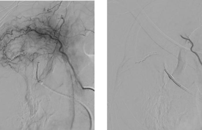 Petites particules pour emboliser les artères bronchiques périphériques