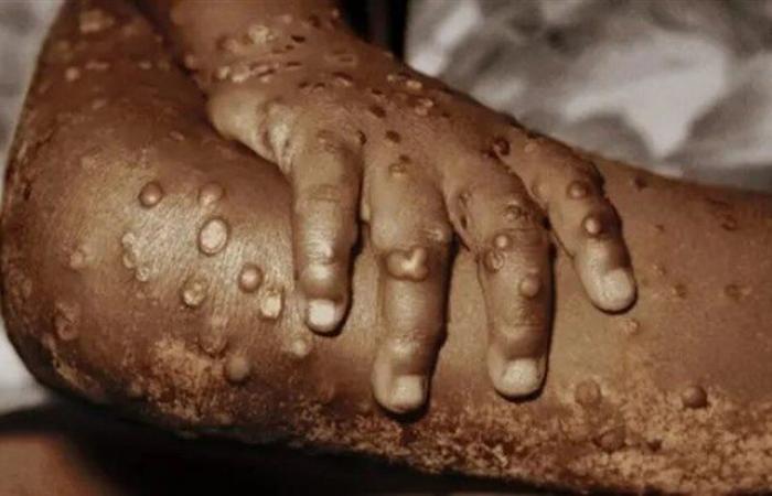 Un autre cas confirmé de Mpox dans le pays, cette fois à Uíge