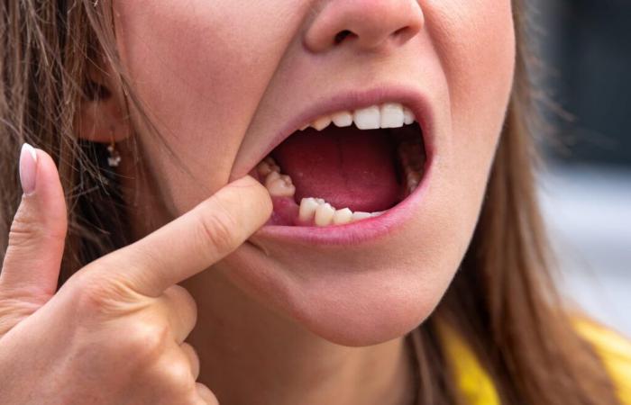 Fini les trous dans les dents, les Japonais ont trouvé un médicament pour faire repousser les dents