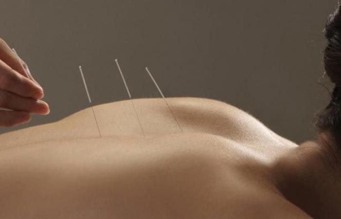 Séances d’acupuncture accessibles avec un tarif spécial pour les patients