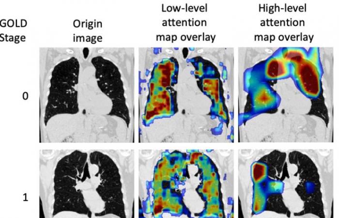 Diagnostic de la BPCO par tomodensitométrie ponctuelle assistée par un réseau neuronal