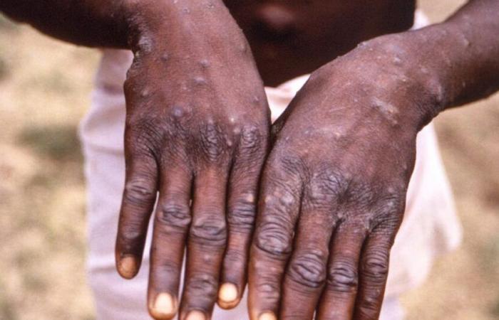 La Sierra Leone signale le premier cas confirmé de mpox