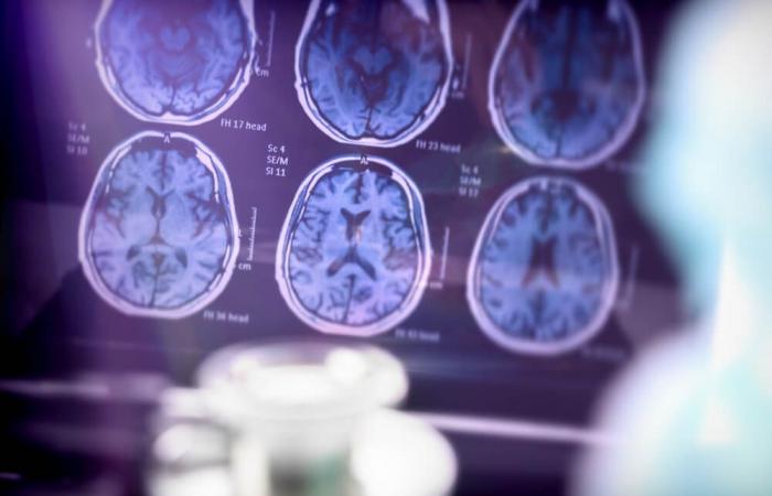 4 millions d’euros pour faire avancer la recherche sur Alzheimer