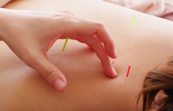 L’acupuncture s’avère efficace contre la sciatique