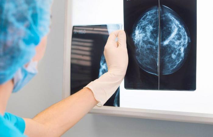 L’IA augmente les détections du cancer du sein de 18 %