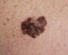 La campagne Euromélanome cible les Belges sujets à la récidive du cancer de la peau
