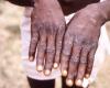 Congo-Brazzaville : épidémie de variole du singe déclarée après 59 cas détectés
